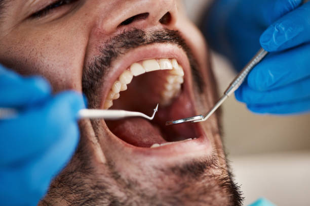 Best Emergency Wisdom Tooth Extraction in Keeler Farm, NM